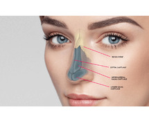 Nose surgery cost in Delhi - Dr Rajat Gupta