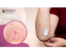 Effective Skin Psoriasis Treatment in Bangalore