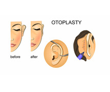 Otoplasty Surgery in Delhi - Dr Rajat Gupta