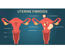Is Your Health at Risk? What to Know About Uterine Fibroids