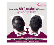 Best Hair Transplant Treatment Clinic Bhubaneswar – Rupam Clinic