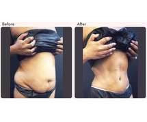 Tummy Tuck Surgery cost in Delhi - Dr Rajat Gupta