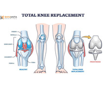 Life After Knee Replacement Surgery: What to Expect