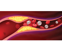 EECP Therapy for 80-90% Blockage: Can It Help You Avoid Bypass Surgery?