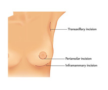 Choosing the Right Surgeon for Breast Augmentation
