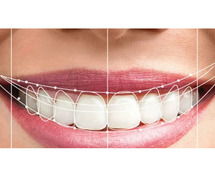 Smile Designing Price in Ahmedabad | Somani Orthodontic