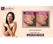 Advanced Vitiligo Treatment in Bangalore
