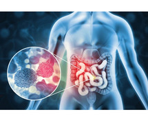 Spot It Before It Spreads: The Power of Early Colorectal Cancer Detection