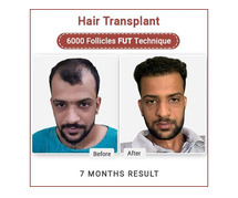 Hair Transplant In India