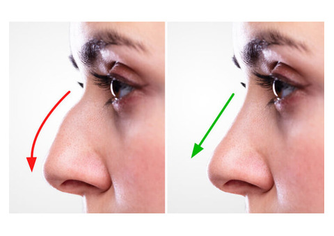Why Patients Choose Revision Rhinoplasty | Expert Nose Surgery by Dr. Lokesh Handa