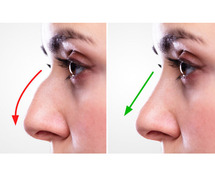 Why Patients Choose Revision Rhinoplasty | Expert Nose Surgery by Dr. Lokesh Handa