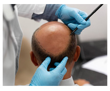 Best Hair Transplant in Delhi  by Dr. Lokesh Handa