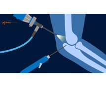 Arthroscopic Surgery Recovery Time: What to Expect