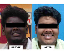 Skin Pigmentation Treatment Near Me