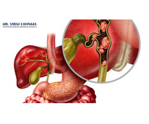 Your Essential Guide to Gallbladder Cancer: Symptoms, Diagnosis, and Hope