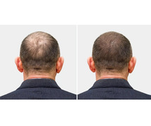 Hair Loss Treatment Near Me