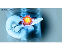 Breaking Down Pancreatic Cancer: From Diagnosis to Specialized Care