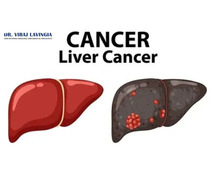 What You Need to Know About Liver Cancer and Its Early Signs