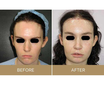 Transgender Facial Feminization Surgery in India