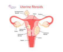 Effective Ways to Manage Pain & Heavy Bleeding from Uterine Fibroids